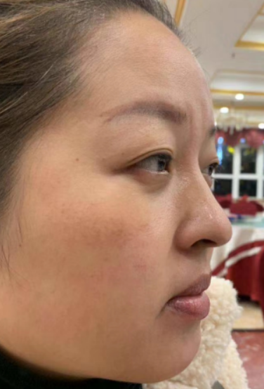 去眼袋手术