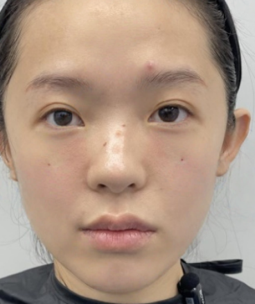 去眼袋手术