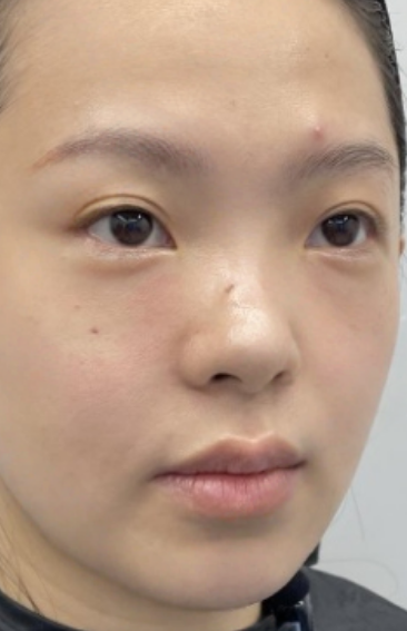 去眼袋手术