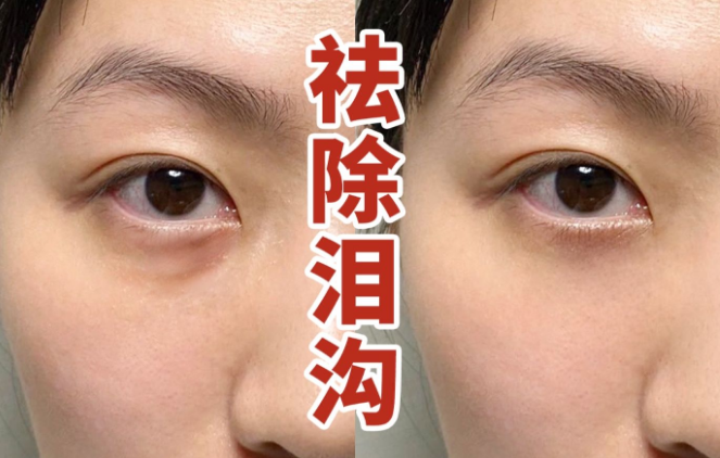 去眼袋手术
