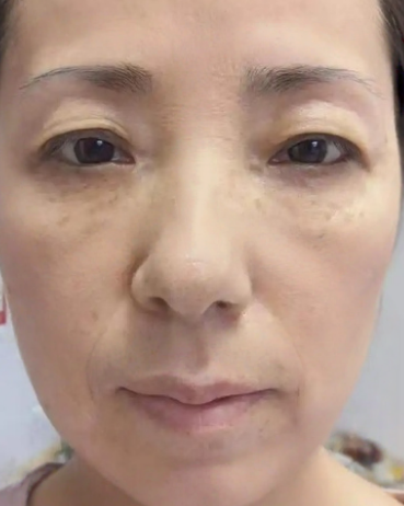 去眼袋手术