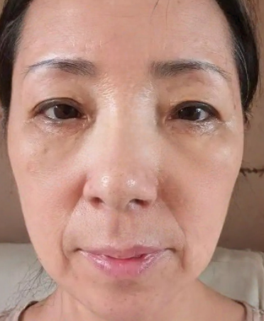 去眼袋手术