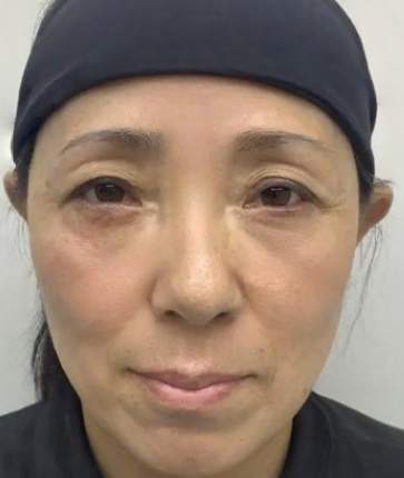 去眼袋手术