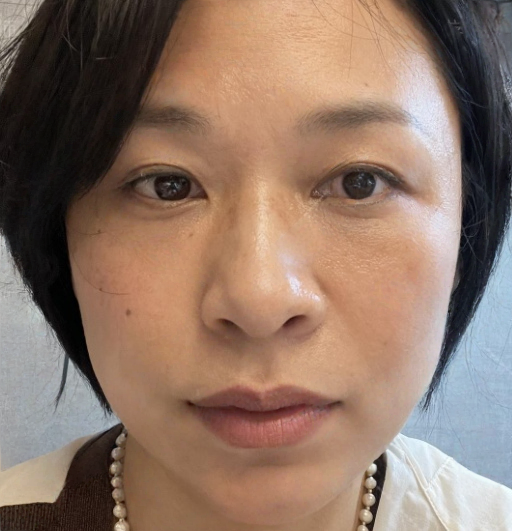 去眼袋手术