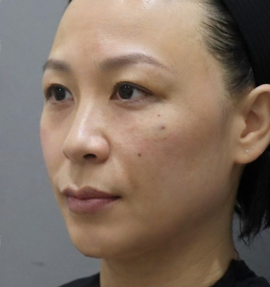 去眼袋手术