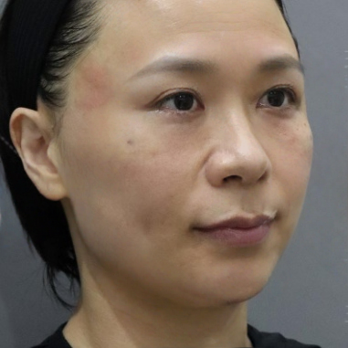 去眼袋手术