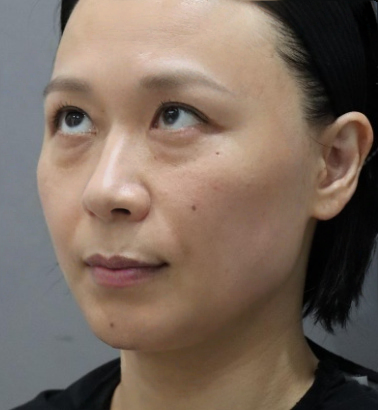 去眼袋手术
