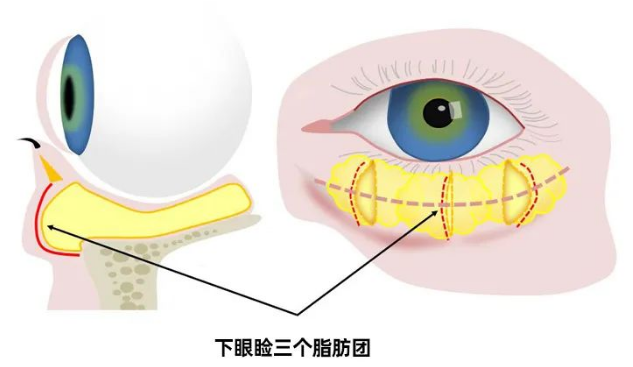 去眼袋手术