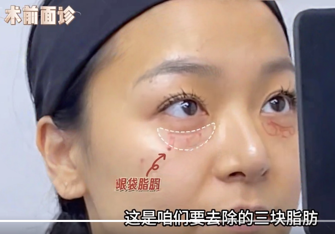 去眼袋手术