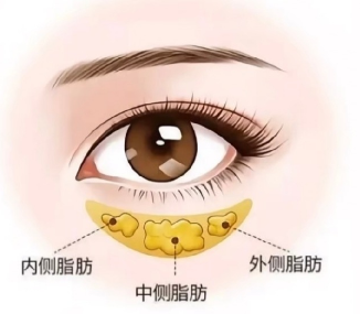 去眼袋手术