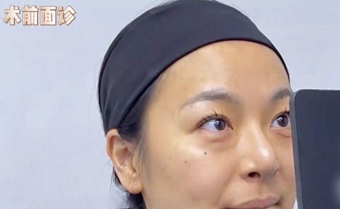 去眼袋手术