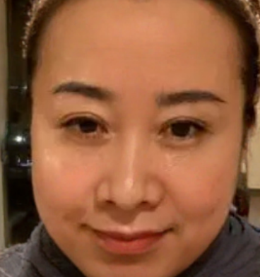去眼袋手术