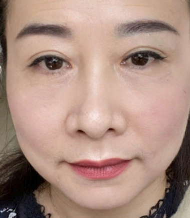 去眼袋手术