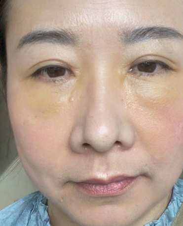 去眼袋手术