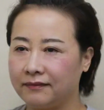 去眼袋手术