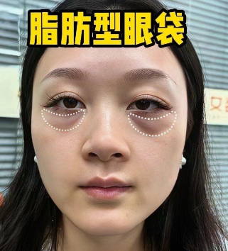 去眼袋手术