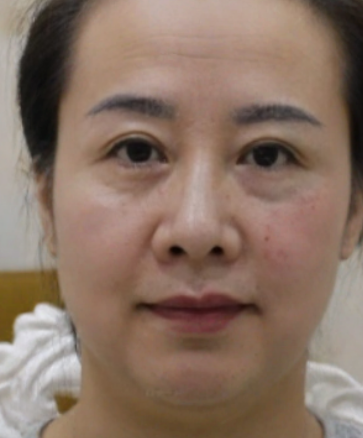 去眼袋手术