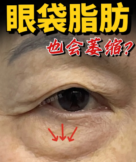 去眼袋手术