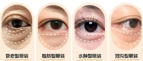 去眼袋手术