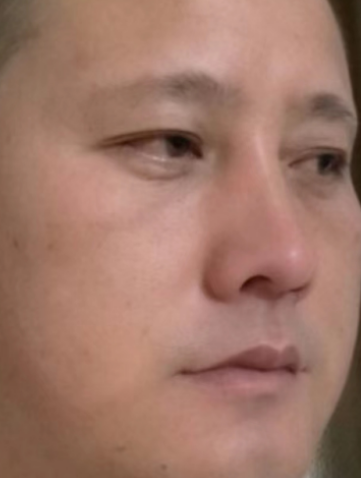 去眼袋手术