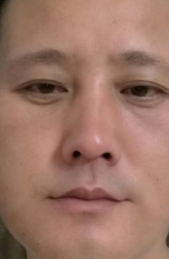 去眼袋手术