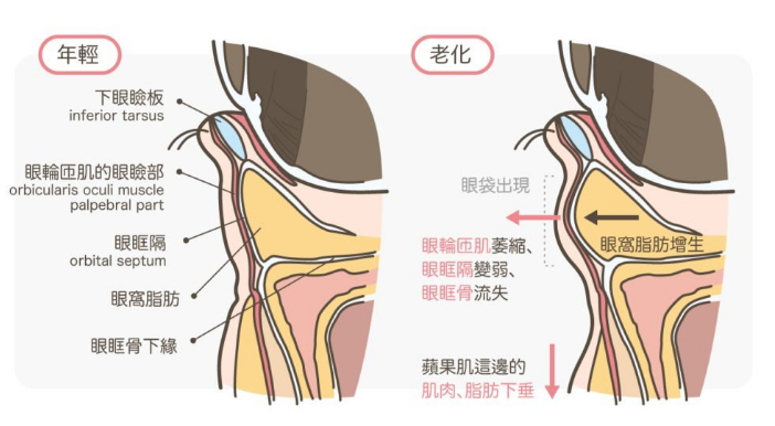 去眼袋手术