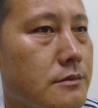 去眼袋手术
