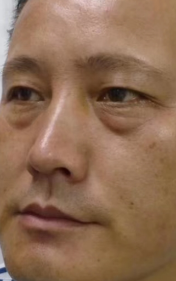 去眼袋手术