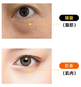 去眼袋手术