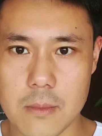 去眼袋手术
