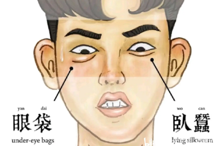 去眼袋手术