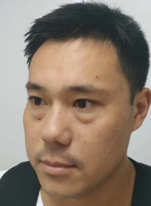 去眼袋手术