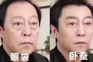 去眼袋手术