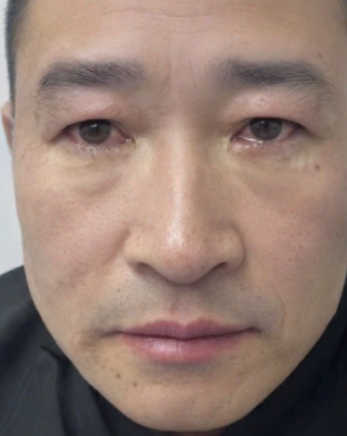 去眼袋手术