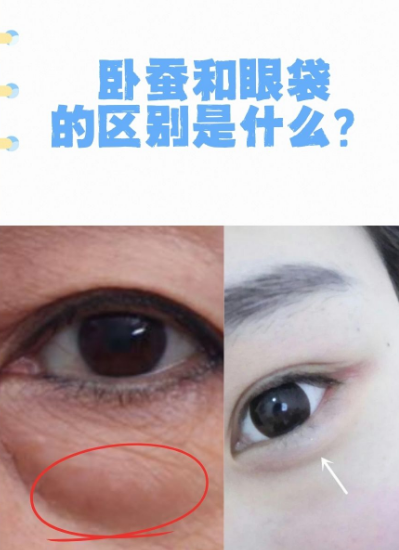 去眼袋手术