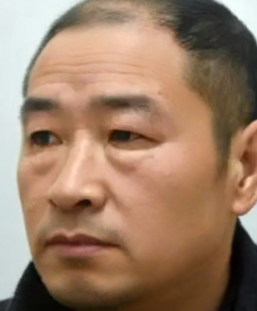 去眼袋手术