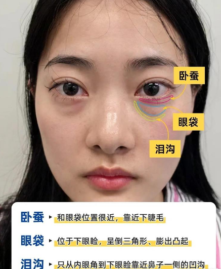 去眼袋手术