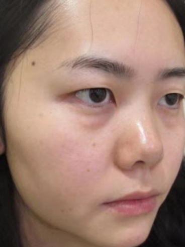 去眼袋手术