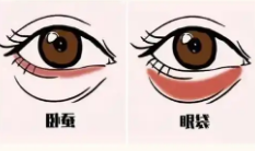 去眼袋手术