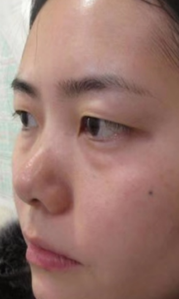 去眼袋手术