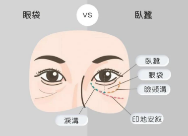 去眼袋手术