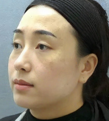 去眼袋手术