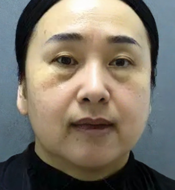 去眼袋手术