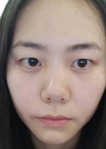 去眼袋手术