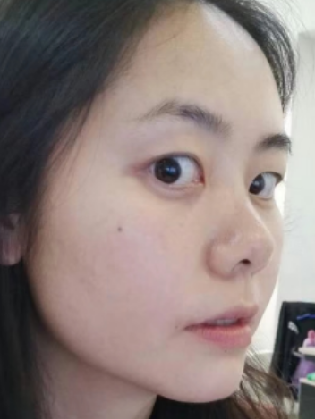 去眼袋手术