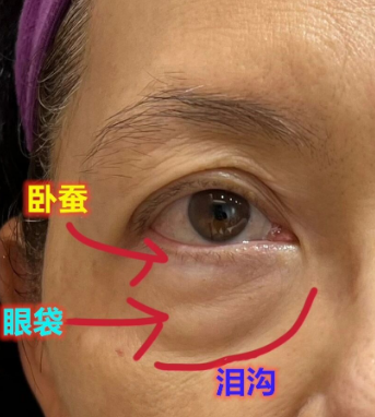 去眼袋手术