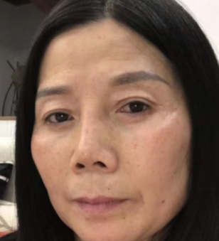 去眼袋手术