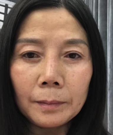 去眼袋手术