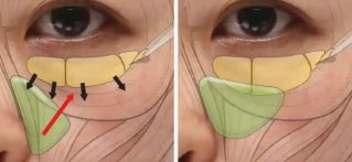 去眼袋手术