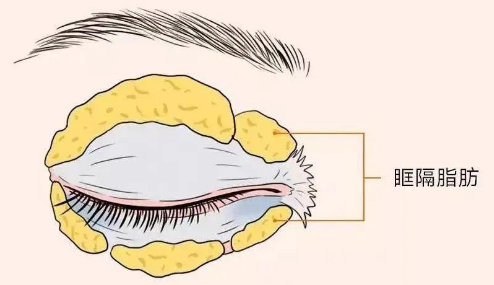 眼袋